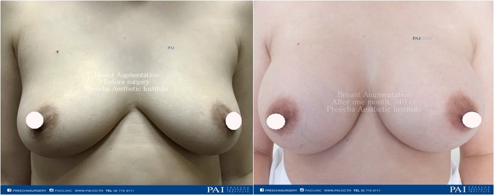 breast implant before and after surgery, preecha aesthetic institute bangkok thailand