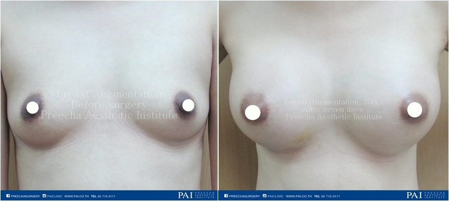 breast implant before surgery after seven days