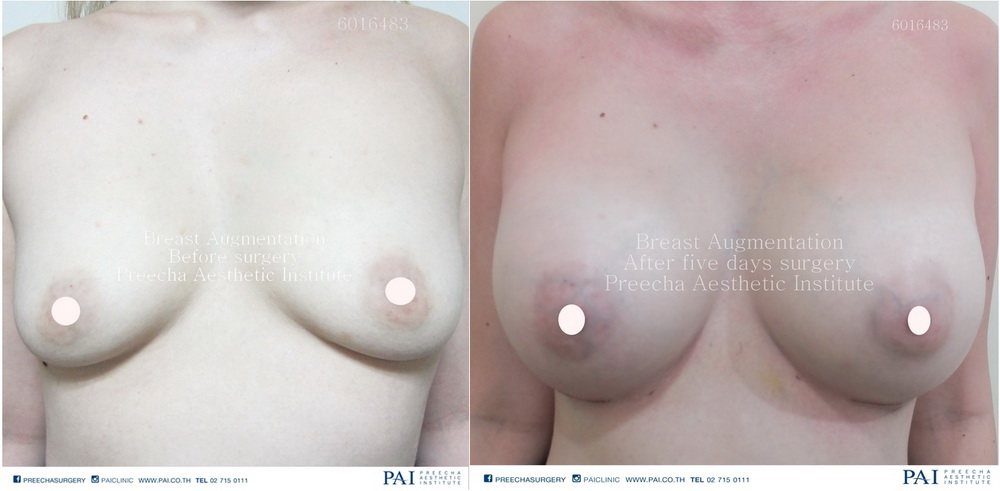 breast implant best surgeon bangkok thailand best clinic cosmetic surgery