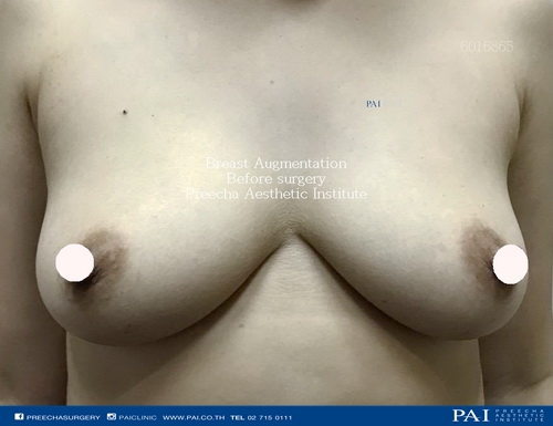 breast implant surgery, preecha aesthetic institute bangkok thailand