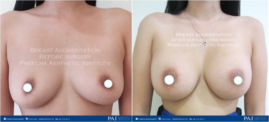 mammoplasty before and after surgery