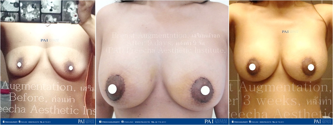 mammoplasty before surgery after surgery