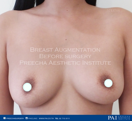 mammoplasty before surgery