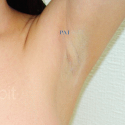 under armpit incision breast implant