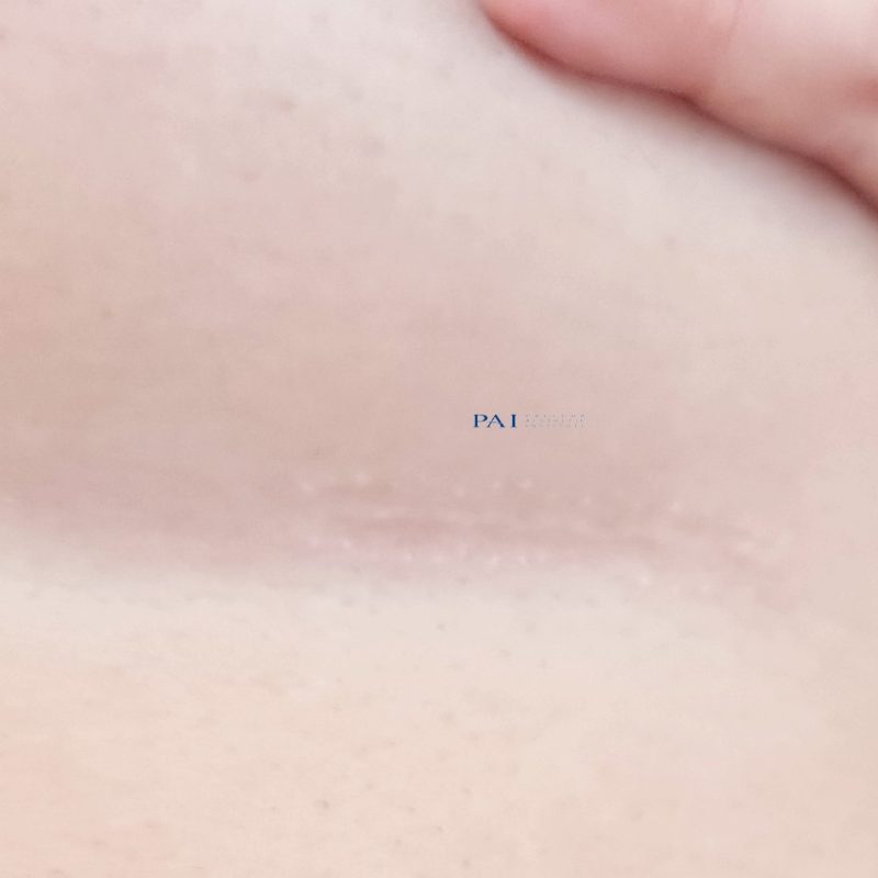 under breast incision for breast augmentation sample result by preecha aesthetic institute
