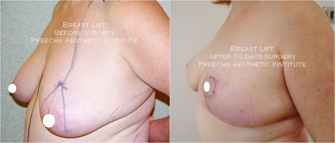 Before and After Breast Lift surgery
