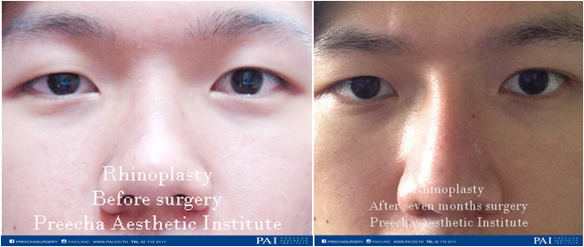 Before man rhino and after seven month surgery preecha aesthetic institute