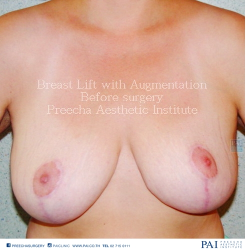 Breast Lift before surgery