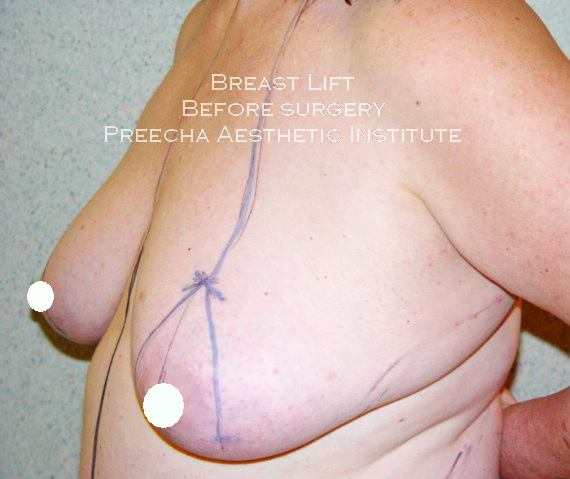 Breast Lift bf