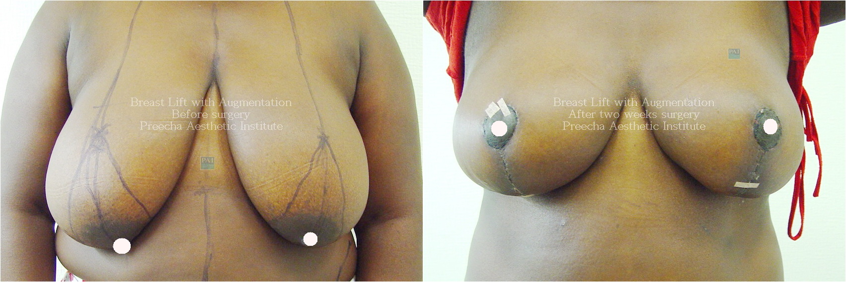 Breast Lift with Augmentation Before and After two weeks