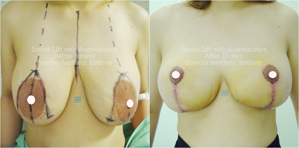 Breast Lift with Augmentation before and after ten days