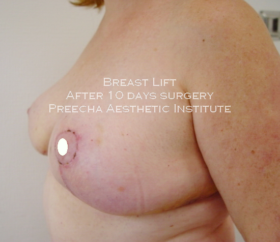 breast lift after 10 days