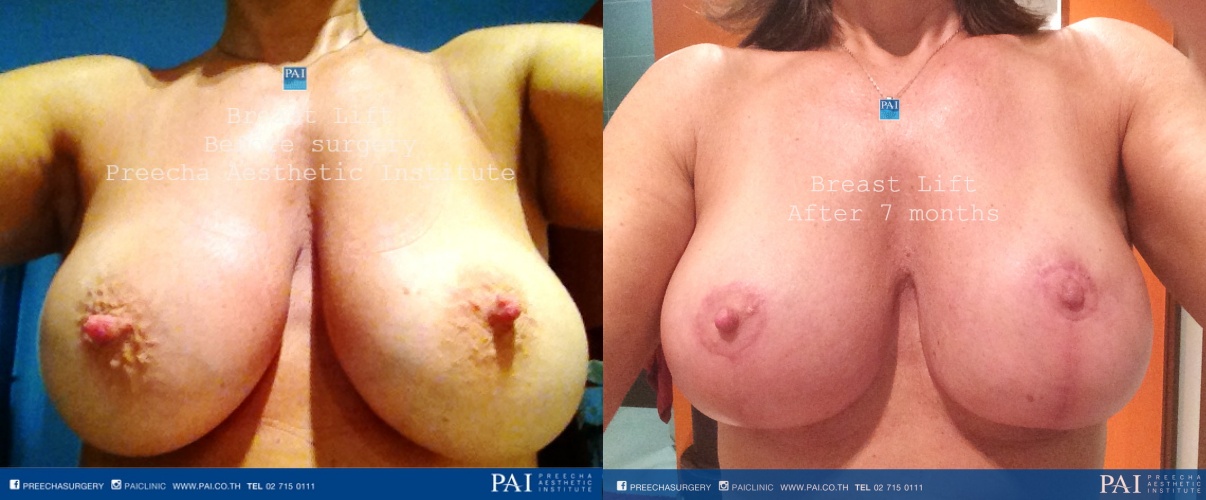 breast lift before and after surgery