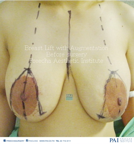 breast lift before l preecha aesthetic bangkok