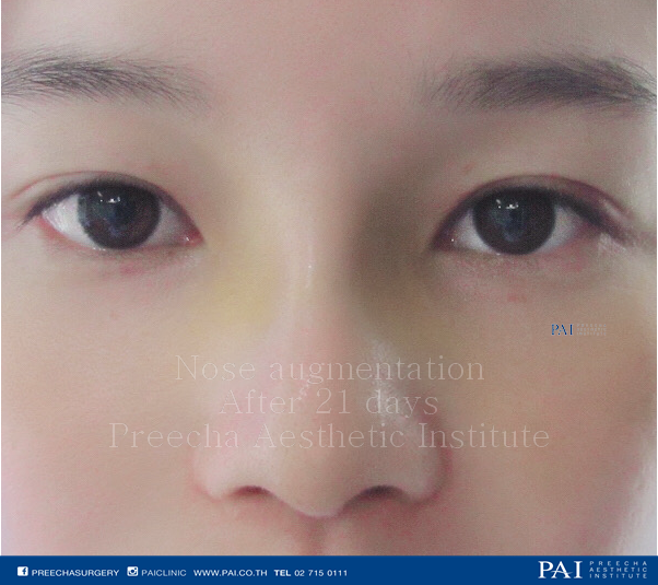 nose augmentation after 21 days surgery l preecha aesthetic institute bangkok thailand