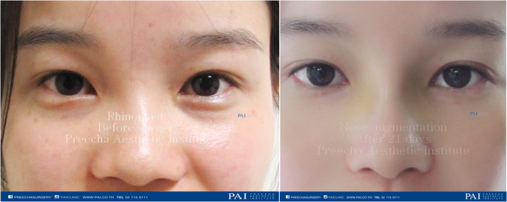 nose augmentation before and after 21 days surgery l preecha aesthetic institute bangkok thailand
