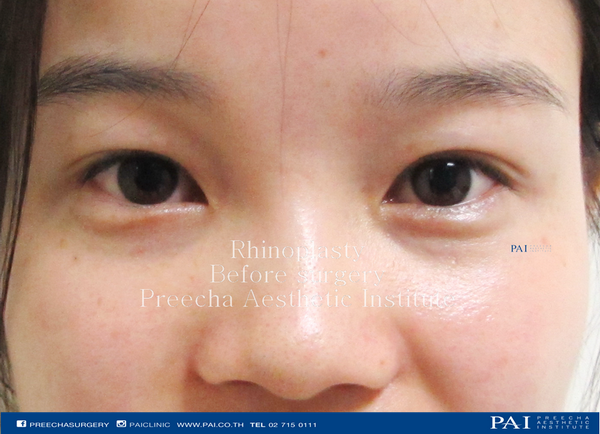 nose augmentation before surgery l preecha aesthetic institute bangkok thailand