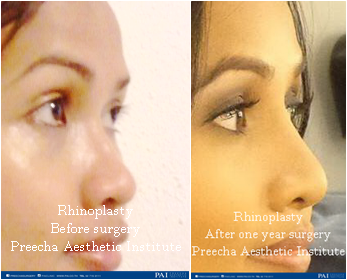 rhino before and after one year surgery preecha aesthetic institute