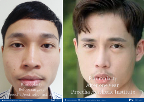 rhino before surgery and after one year preecha aesthetic institute horz