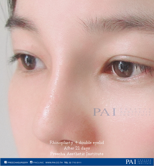 rhinoplasty and double eyelid after 21 days surgery preecha aesthetic institute