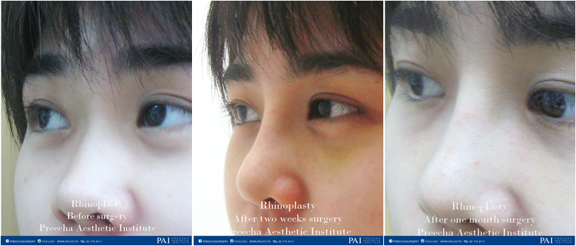 rhinoplasty before and after two weeks and one month preecha aesthetic institute