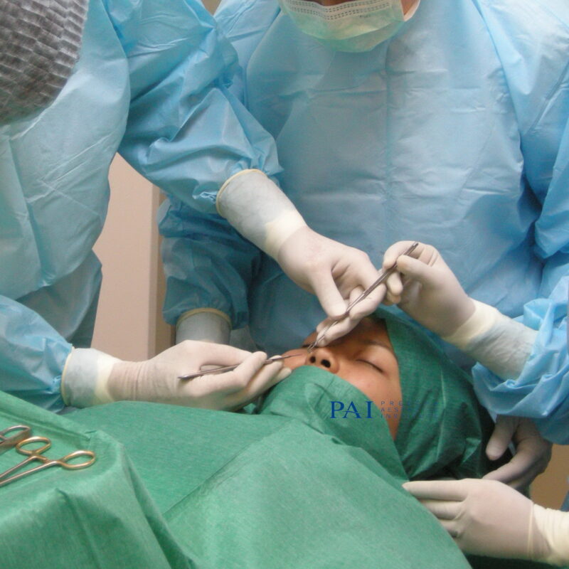 rhinoplasty during operation sample picture preecha aesthetic institute