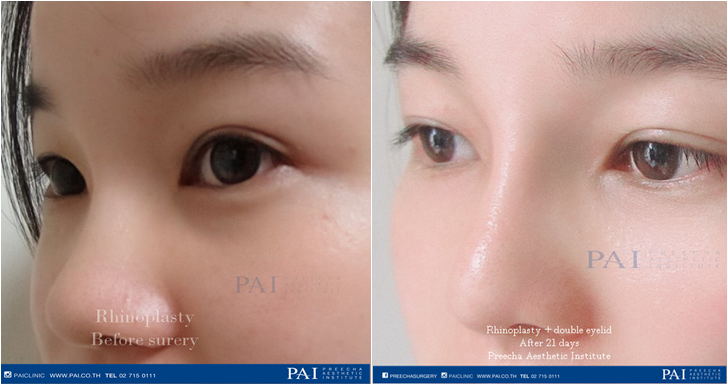rhinoplasty with double eyelid before and after three weeks surgery