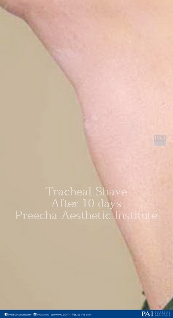 tracheal shave after surgery preecha aesthetic institute