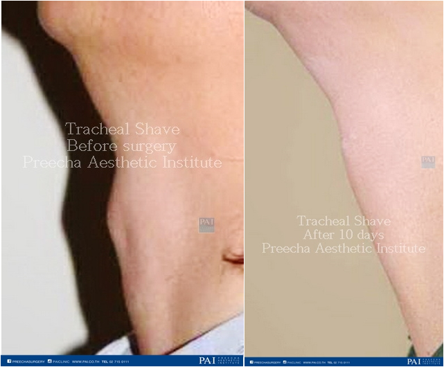 tracheal shave before and after surgery preecha aesthetic institute