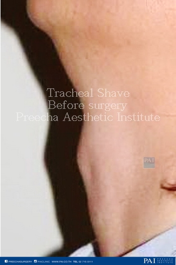 tracheal shave before surgery preecha aesthetic institute