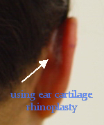 using ear cartilage rhinoplasty preecha aesthetic institute