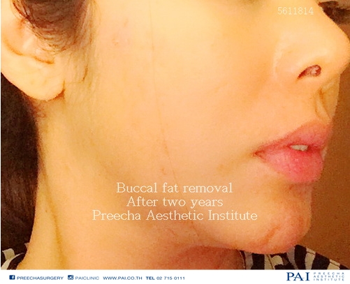 after buccal fat removal two years l Preecha Aesthetic Institute