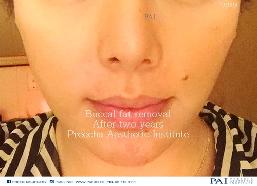 after two years buccal fat removal surgery l Preecha Aesthetic Institute