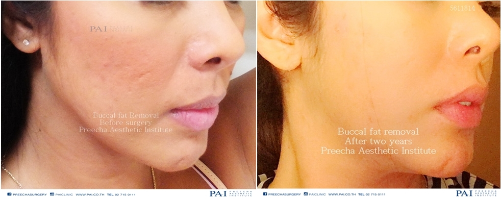 buccal fat removal before and after two years l Preecha Aesthetic Institute