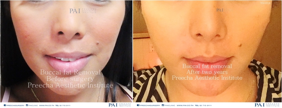 buccal fat removal before and two years surgery l Preecha Aesthetic Institute