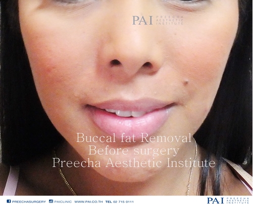 buccal fat removal before surgery l Preecha Aesthetic Institute