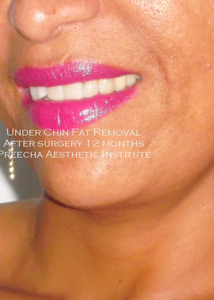 After under chin lipo one year