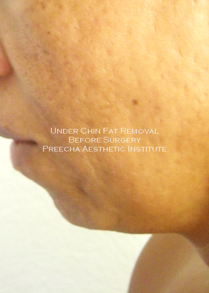 Before under chin fat removal liposuction