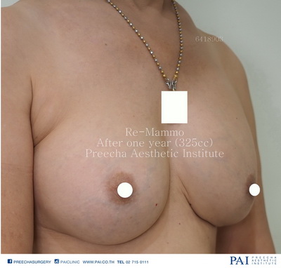 Re mammo after surgery by preecha aesthetic institute