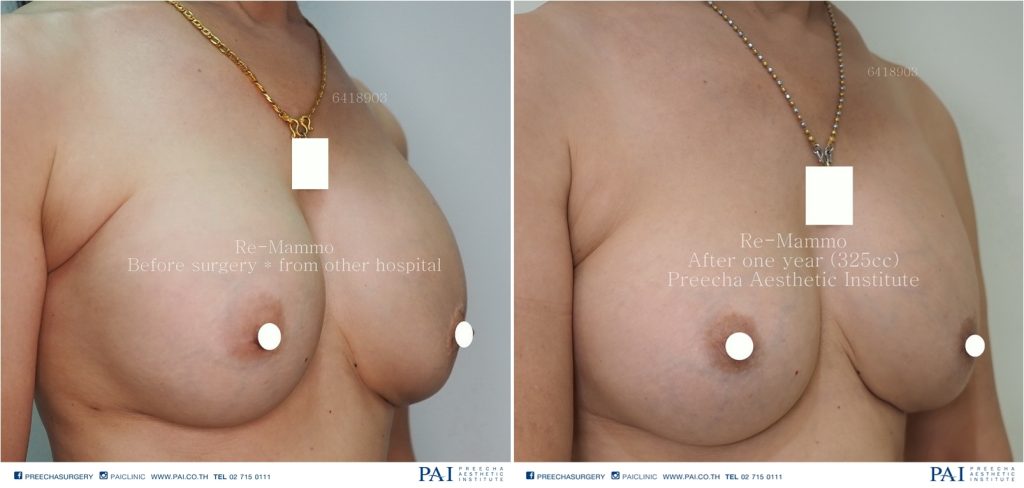 Re mammo before and after surgery by preecha aesthetic institute