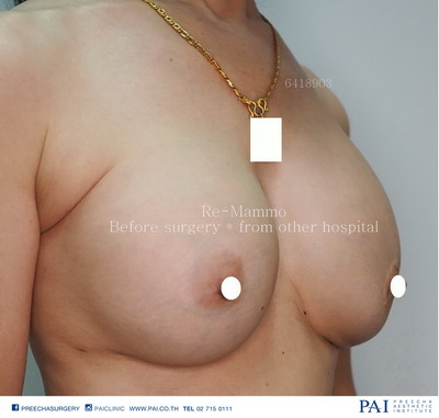 Re mammo before surgery by preecha aesthetic institute