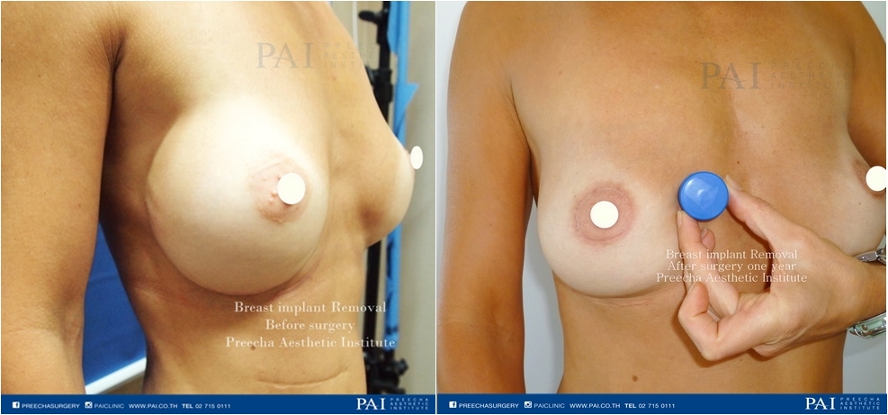 Remove breast implant before and after one year surgery l Preecha Aesthetic Institute