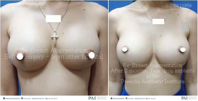 Revision breast augmentation before and aftersurgery tear drop implant