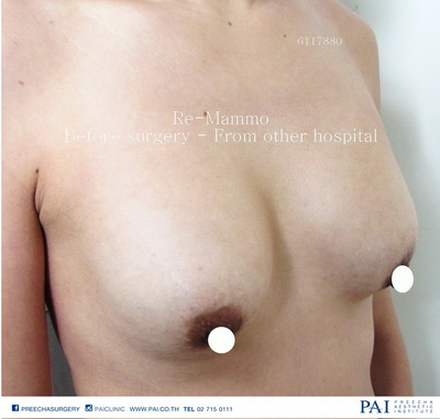Revision breast augmentation before surgery by preecha aesthetic institute