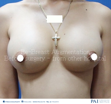 Revision breast augmentation before surgery