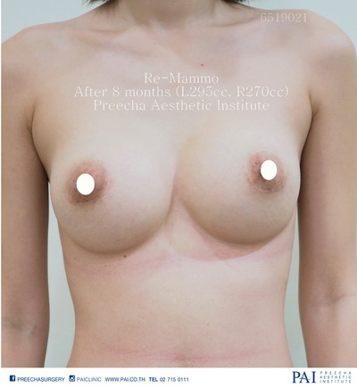 breast augmentation revision after surgery
