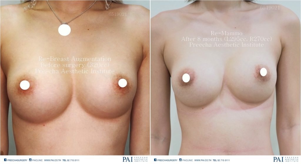 breast augmentation revision before and after surgery