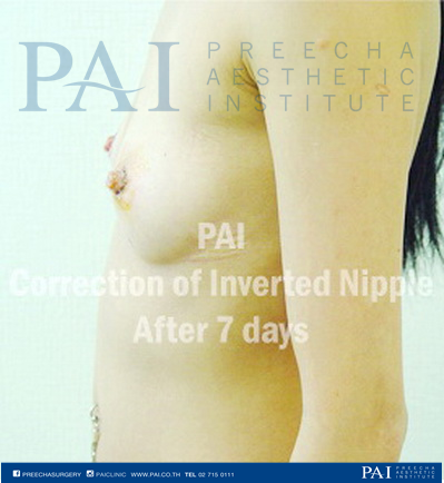 nipple invert surgery after seven day l preecha aesthetic institute
