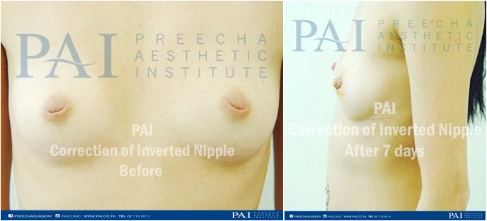 nipple invert surgery before and after surgery l preecha aesthetic institute 