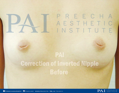 nipple invert surgery before l preecha aesthetic institute